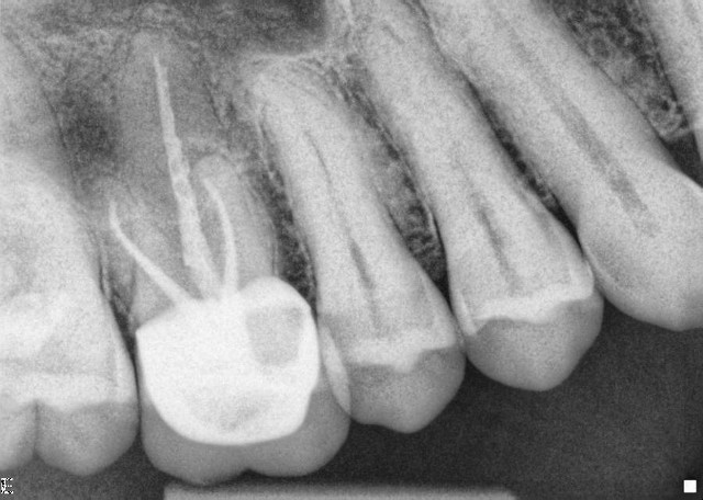 root canal