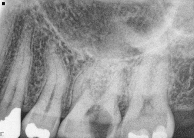 Molar extraction