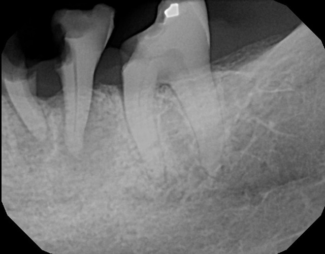 Molar extraction 