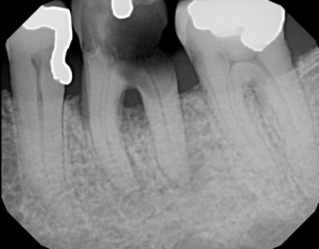 Molar extraction