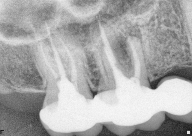 root canal