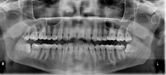 panoramic x-ray panoramic x-ray