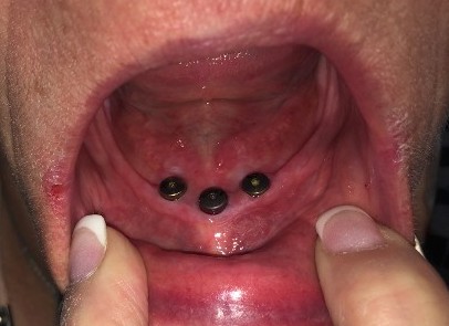 3 implants 