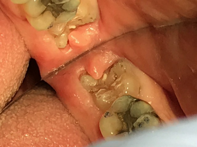 wisdom tooth extraction