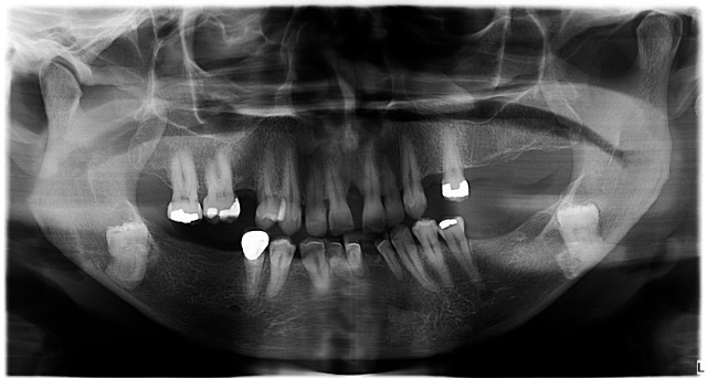panoramic x-ray panoramic x-ray