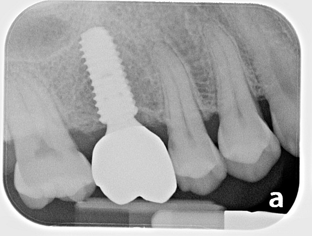 dental implant 