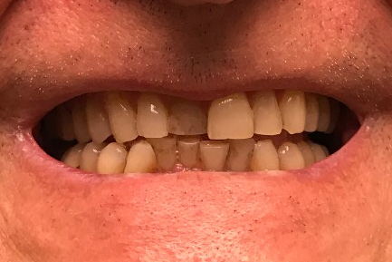 veneer case