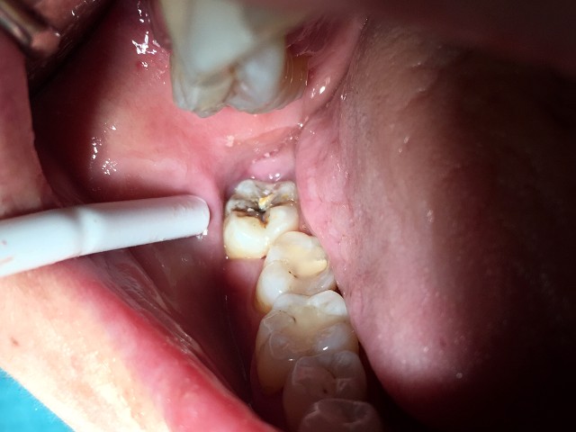 Wisdom tooth extraction