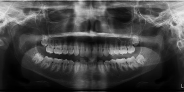 wisdom teeth wisdom teeth