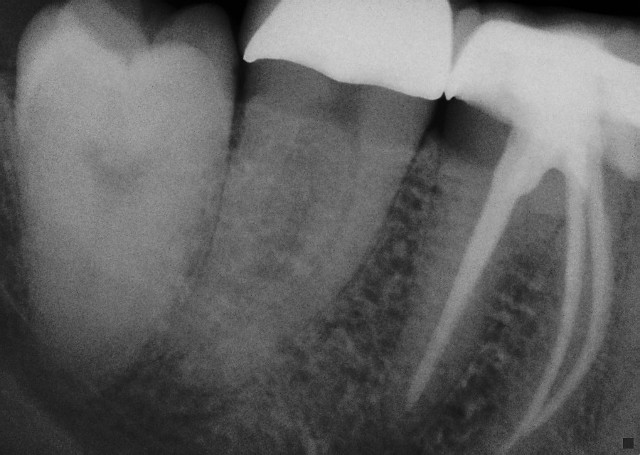 Wisdom tooth extraction