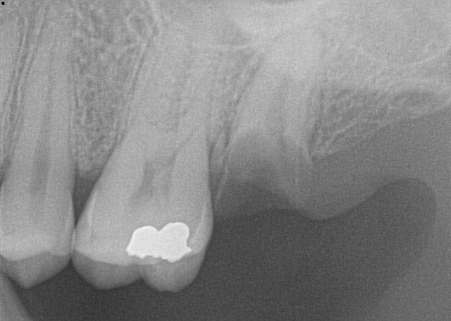 Molar extraction 