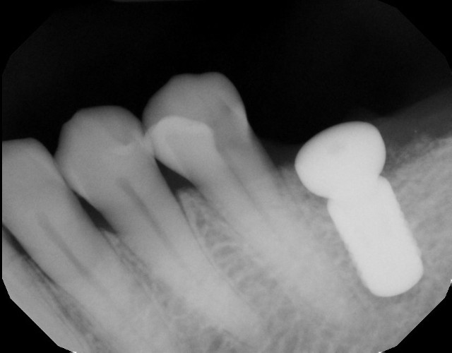 premolar RCT