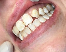 veneer case