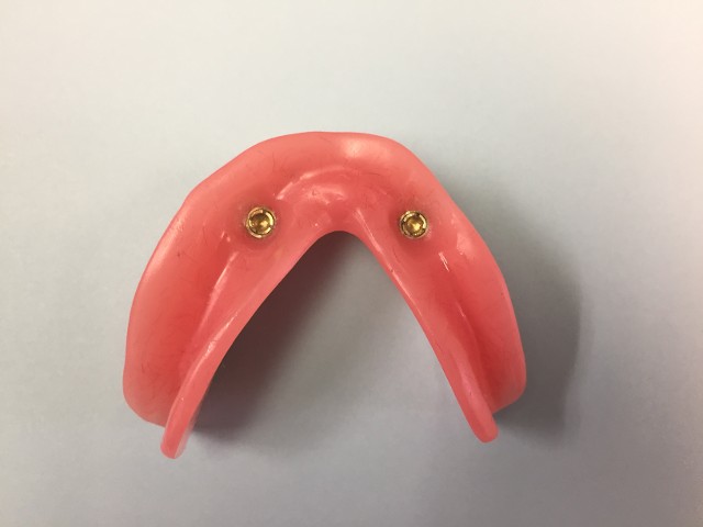 implant retained denture