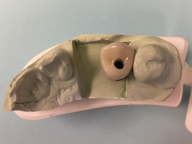 implant crown