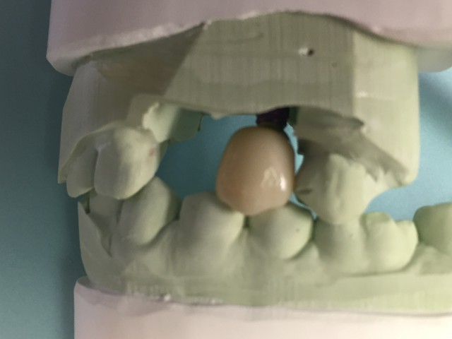 implant crown 