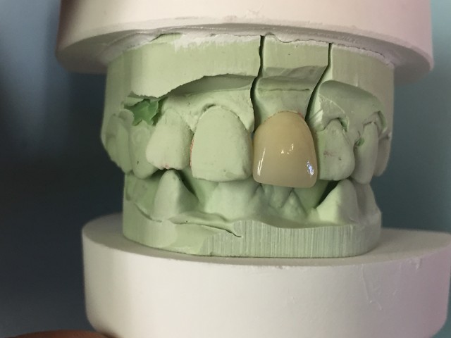 anterior crown