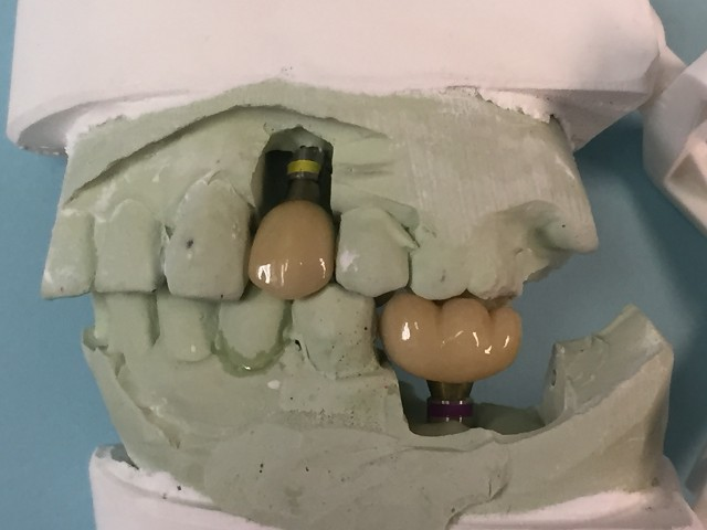 implant crowns