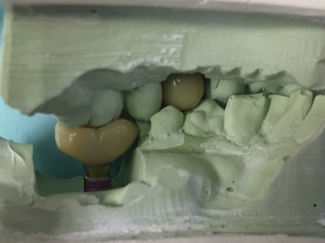 implant crowns 