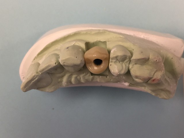 implant crown