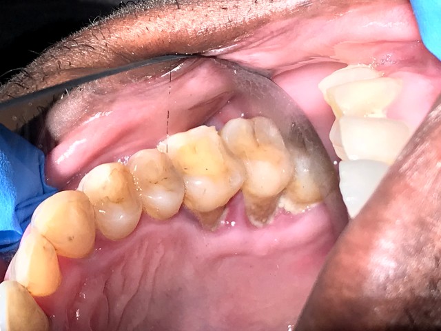 soft tissue graft 