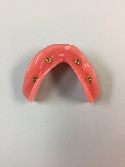 overdenture