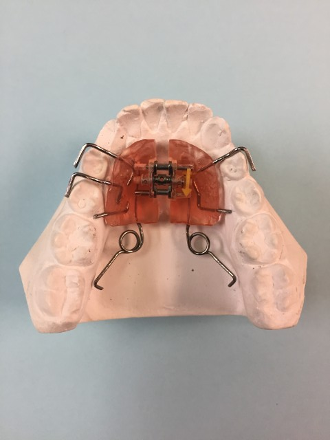 palatal expander