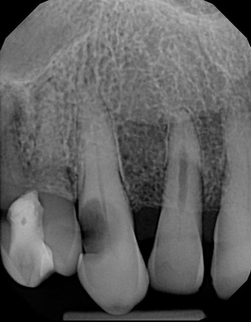 anterior extraction