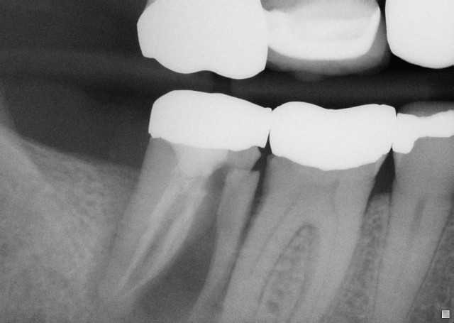 Fractured molar 