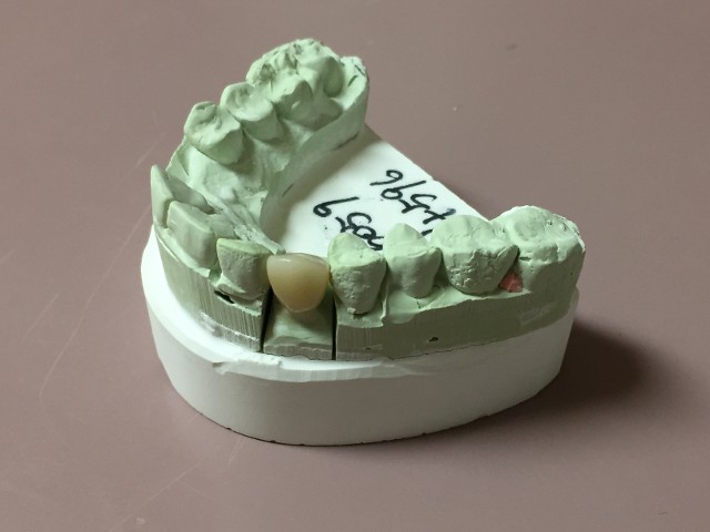 Zirconia crown