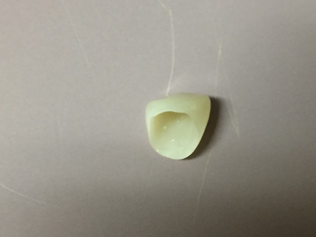 anterior crown