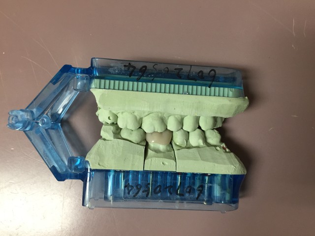 molar crown