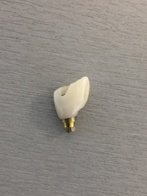 implant crown