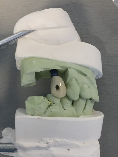 implant crown