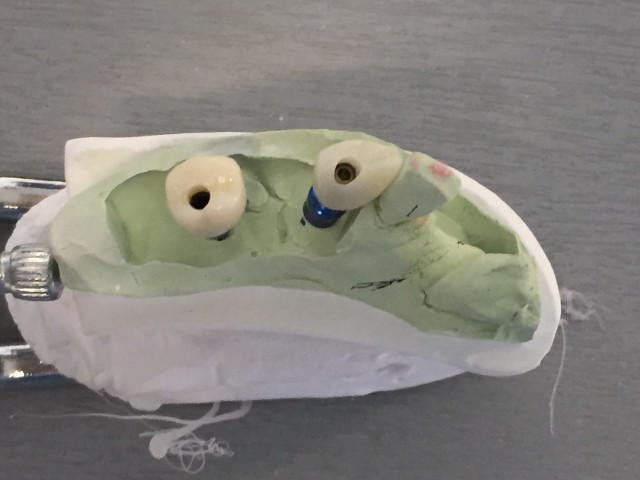 Implant crowns