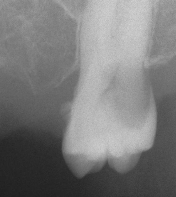 Decayed molar
