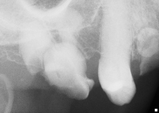 decayed molar