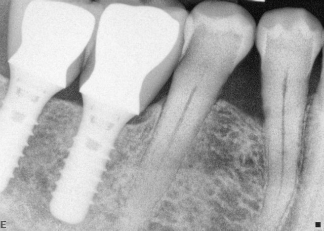dental implants