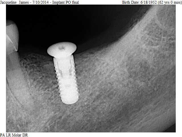 dental implant 