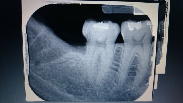 extractions