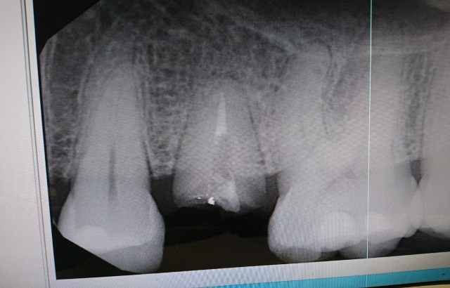PA radiograph