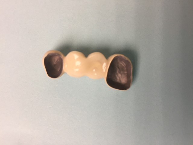 dental bridge