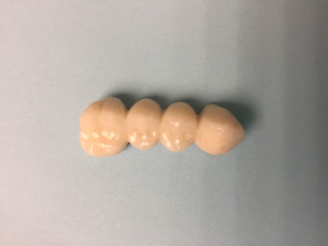 dental bridges