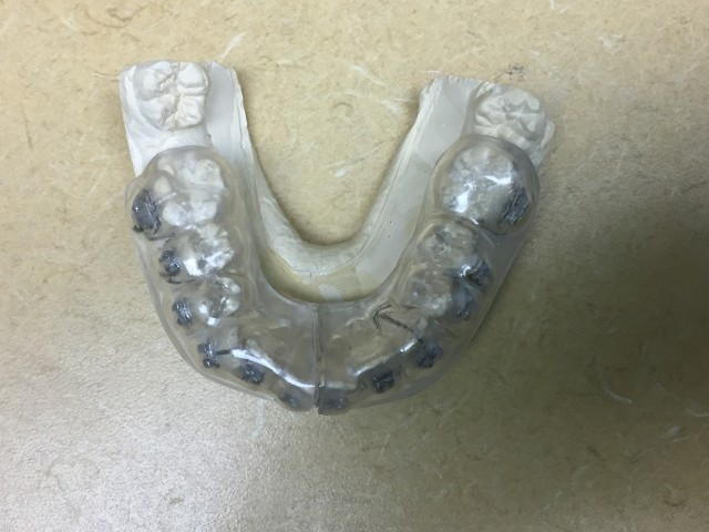 braces