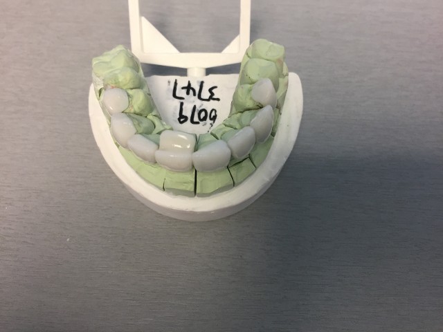 veneers