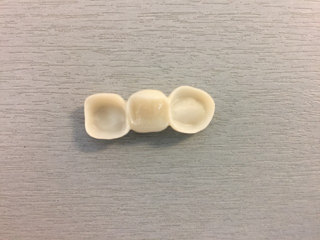 dental bridge