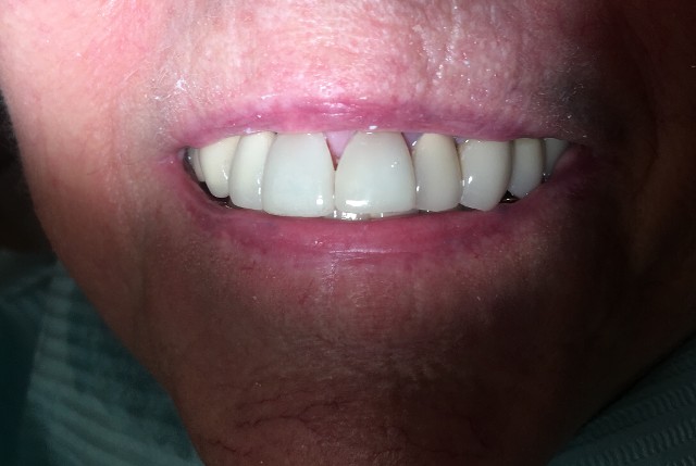 veneers