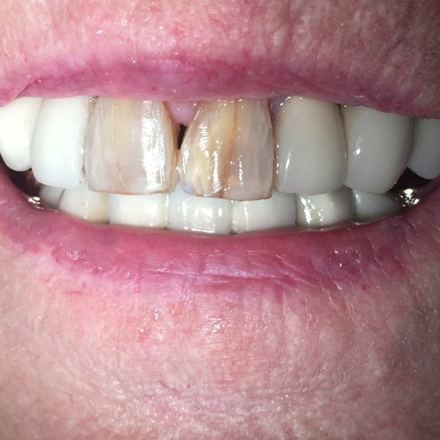 Veneers