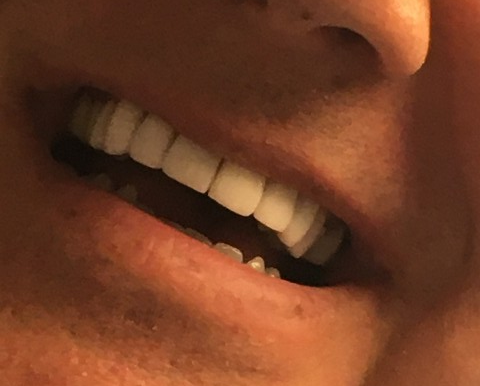 veneers
