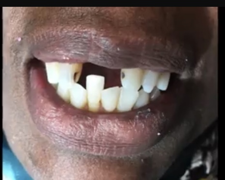 dental bridge